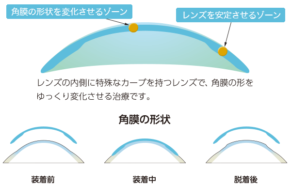 オルソケラトロジー（ナイトレンズ） | おろく眼科