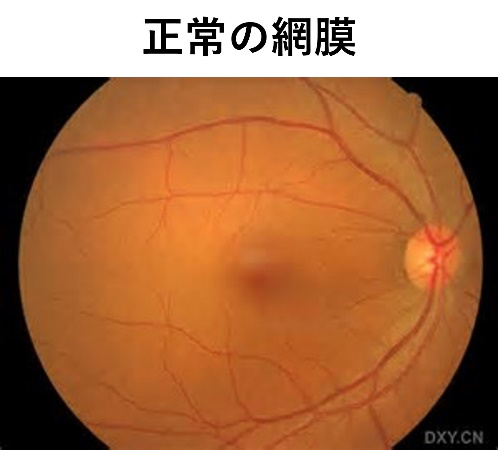 糖尿病網膜症 | おろく眼科